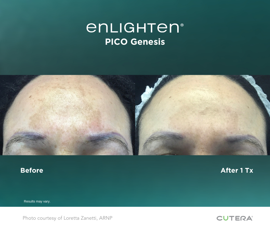 enlighten pico genesis skin acne and pigmentation treatment