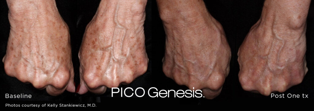 pico genesis skin treatment